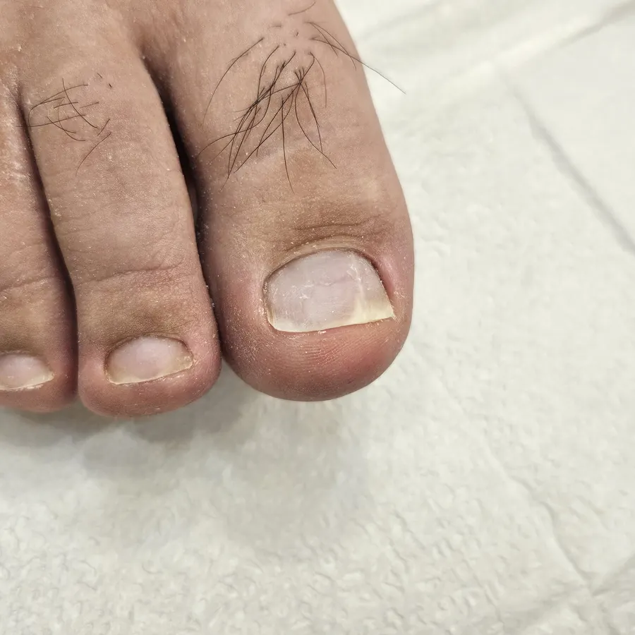파고드는 발톱 — 교정기 치료 후
